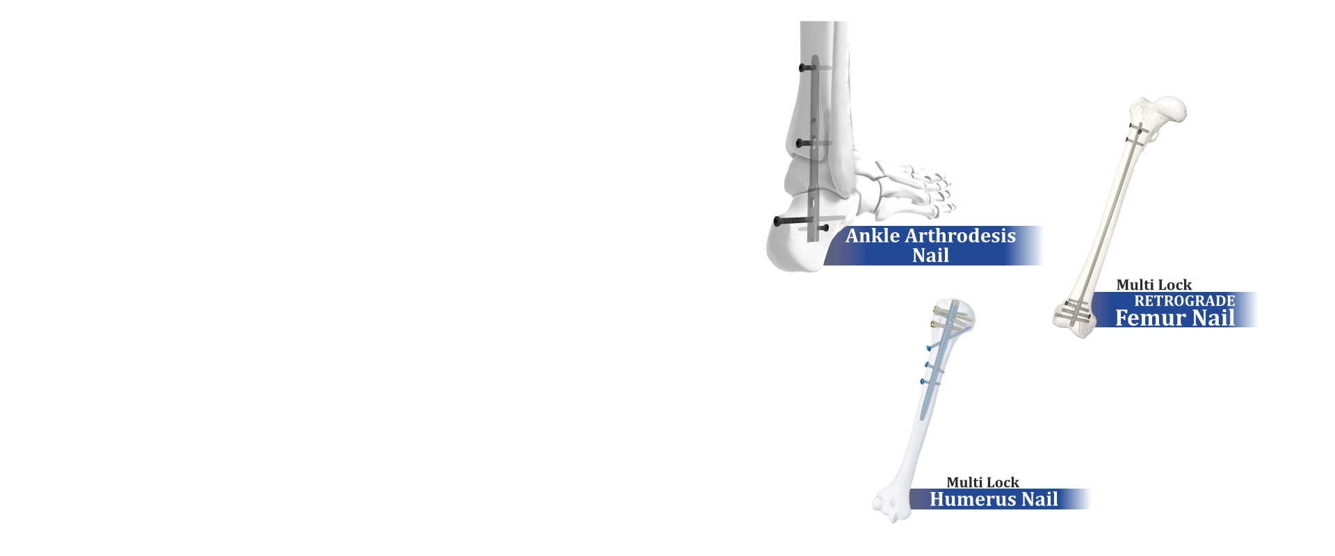 Interlocking Nail System