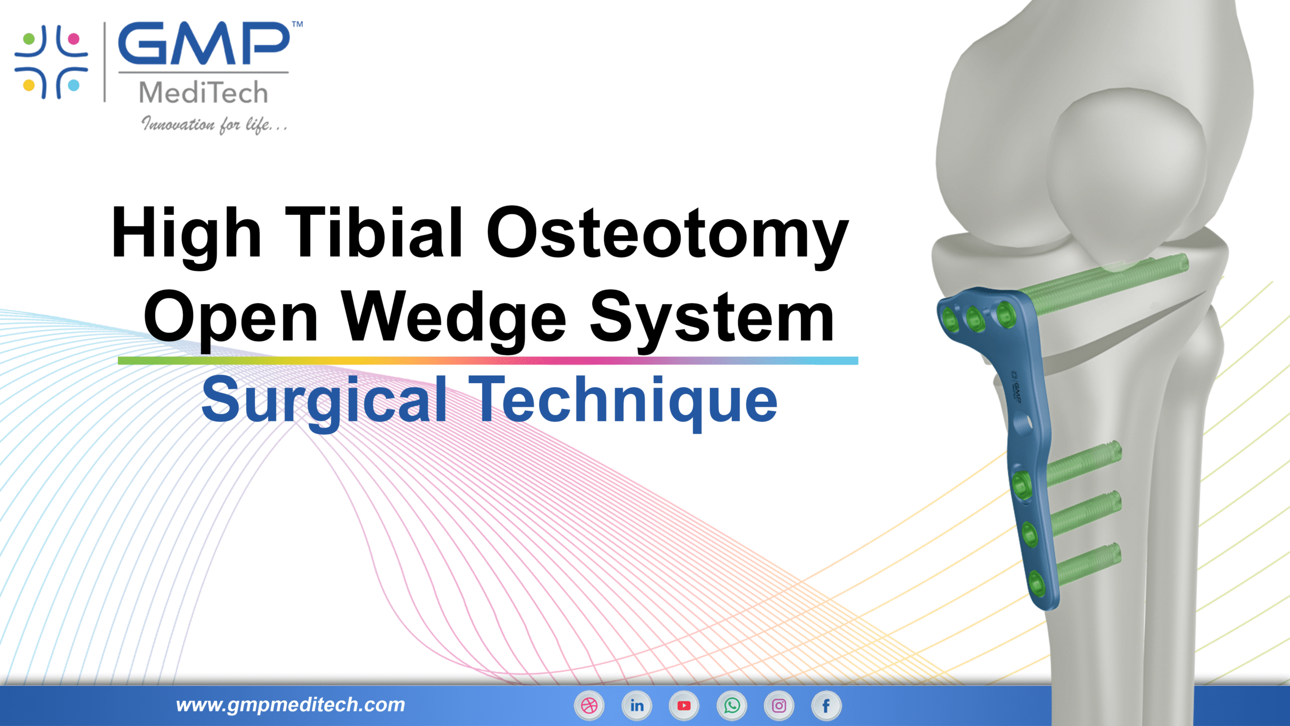 High tibial Osteotomy Open Wedge System – Surgical Technique