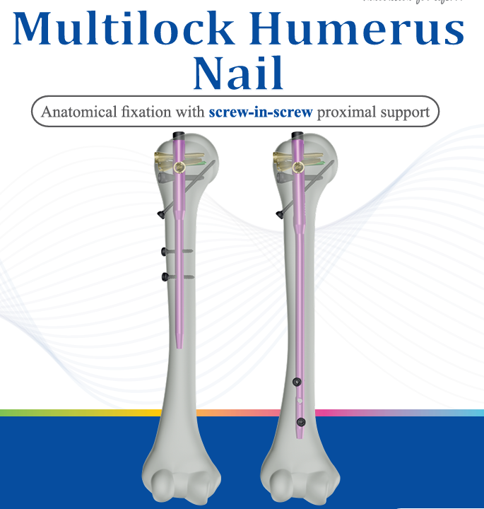Multilock Humerus Nail System