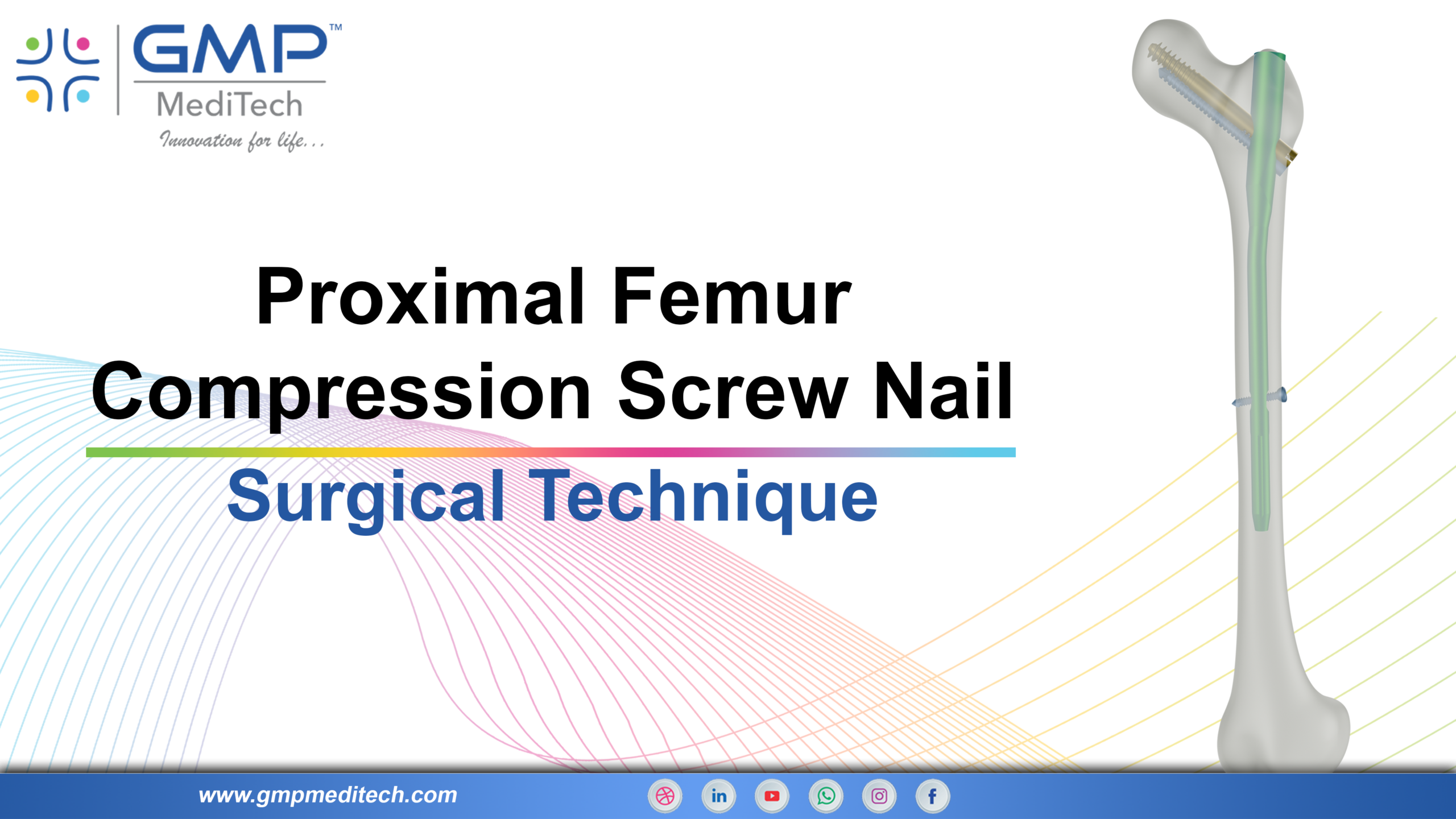 Proximal Femur Compression Screw Nail Surgical Technique