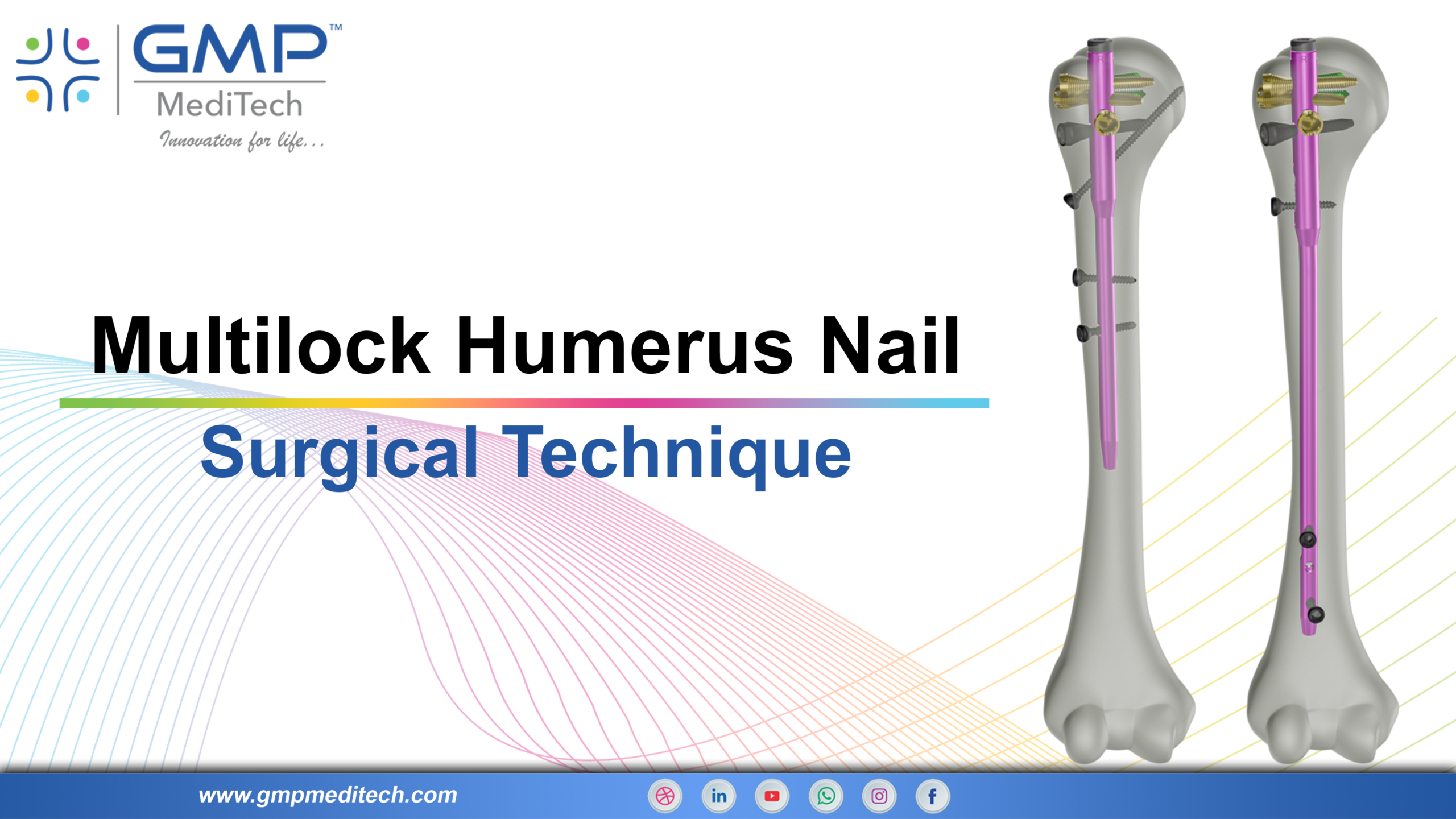 Multilock Humerus Nail Surgical Technique | Proximal Humerus Fracture Fixation